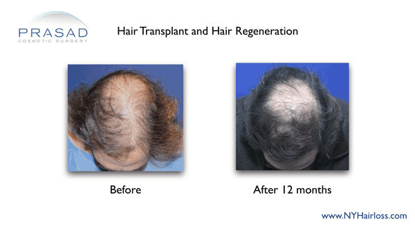 regrow thinning hair naturally